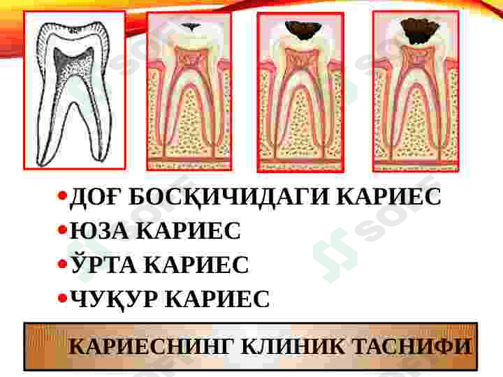 KARIES KASALLIGINI OLDINI OLISH 2
