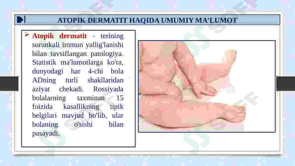 ATOPIK DERMATIT 3