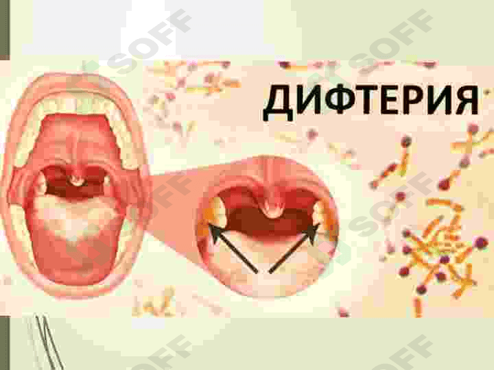 Nafas olish yoʻllari infeksiyalari epidemiologiyasi va profilaktikasi 3