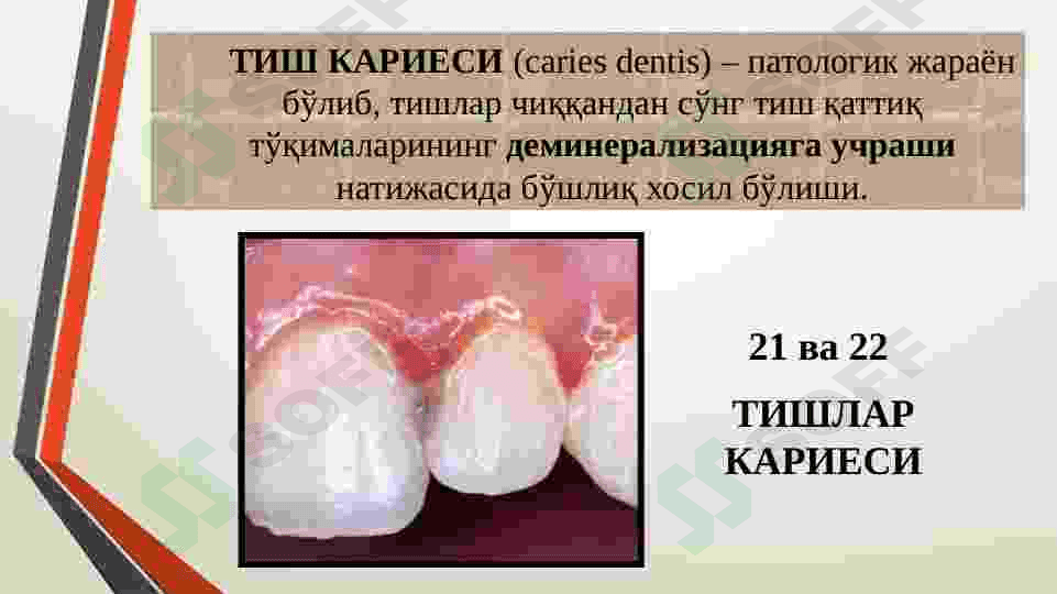 KARIES KASALLIGINI UMUMIY DAVOLASH 3
