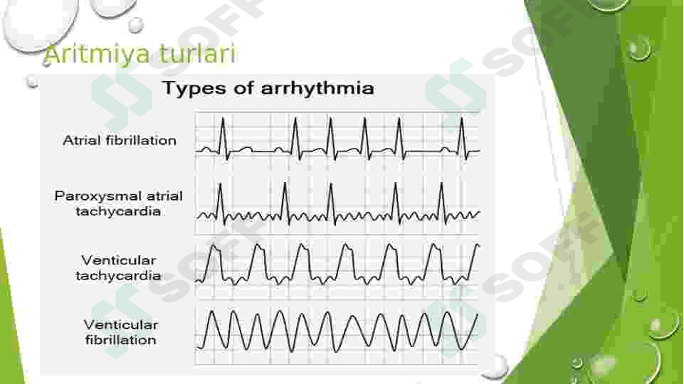 yurak aritmiyalari EKG diagnostikasi 4