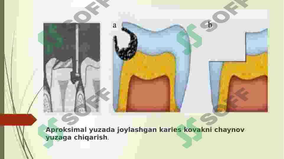 TISH QATTIQ TO`QIMA KASALLIKLARIDA NUQSONNING JOYLASHISH VA CHUQURLIGIGA QARAB KOMPOZIT PLOMBA ASHYOSINI TANLASH MEZONLARI 4