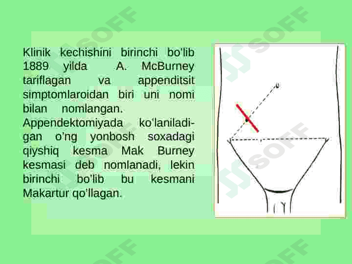 O’tkir appendetsit 5