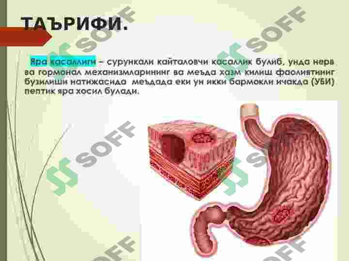 Gastritlar. Me'da va 12 barmoq ichak yara kasalligi ,sabablari, klinikasi va davolash profilaktikasi 7