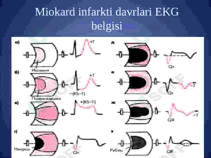 MIOKARD INFARKTI HAQIDA TUSHUNCHA 7