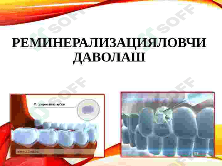 KARIES KASALLIGINI OLDINI OLISH 8