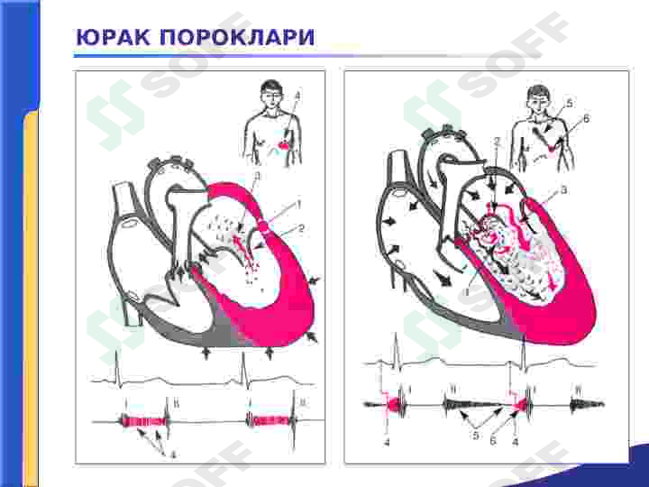 YURAK PAROKLARI.AORTA KLAPANINI YETISHMOVCHILIGI 8