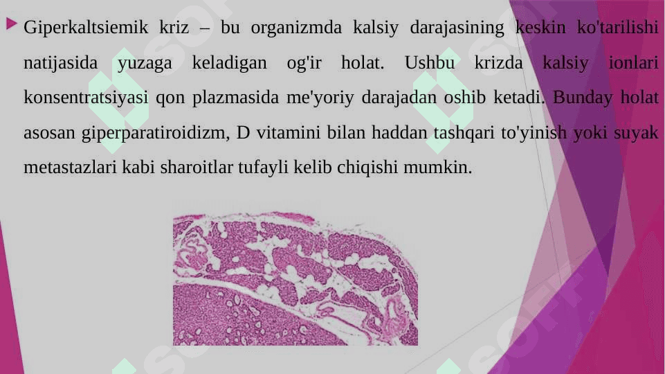 Giperkaltsiemik kriz 3
