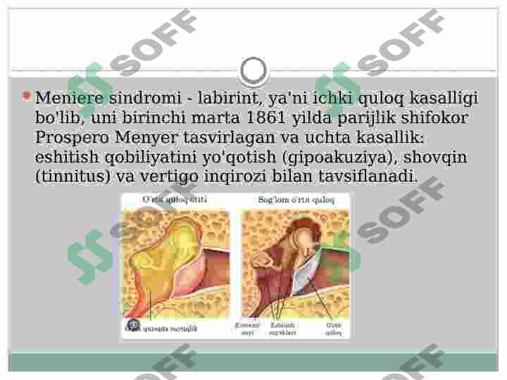 Ichki Quloq Kasalliklari: Meniere Sindromi Yoki Kasalligi 2