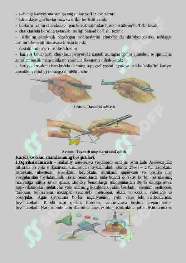 Tish qattiq to‟qimalarini charxlash bosqichlari va tamoyillari. Fantomlarda I sinf karioz bo‟shliqlarini charxlash va plombalash 2