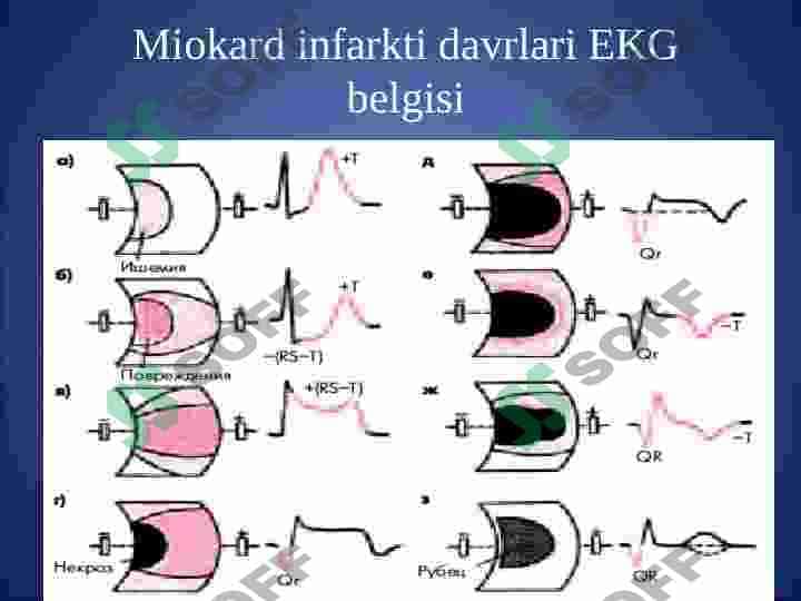 Miokard infarkti 7