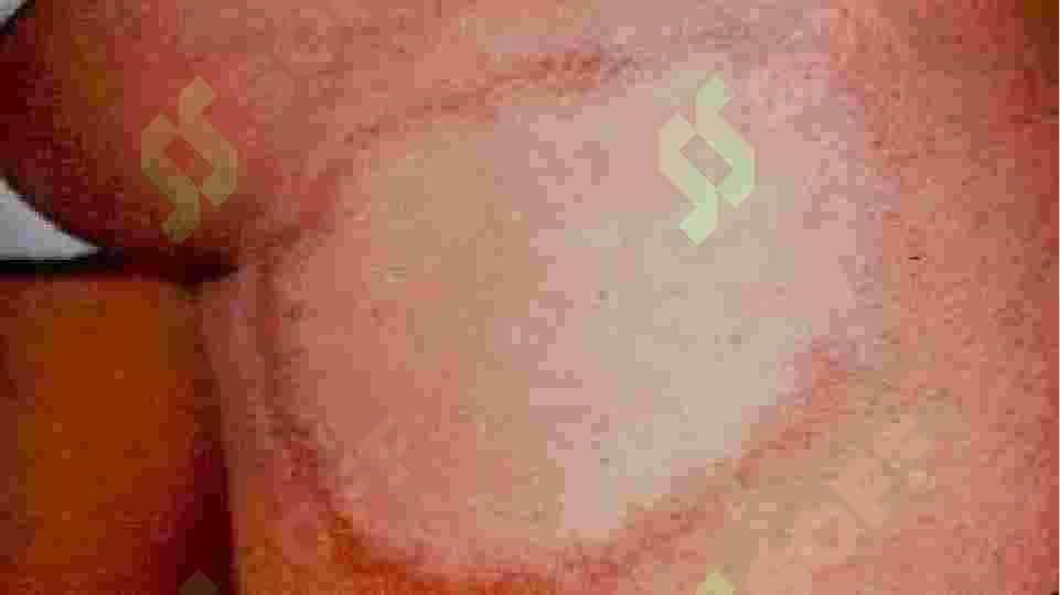 NASLIY DERMATOZLAR 4