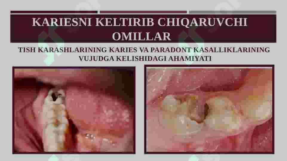 KARIESNI KELTIRIB CHIQARUVCHI  OMILLAR TISH KARASHLARINING KARIES VA PARADONT KASALLIKLARINING  VUJUDGA KELISHIDAGI AHAMIYATI 2
