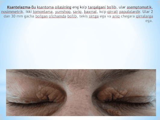 Ksantelazma.Lipoma.Gigromappt 2