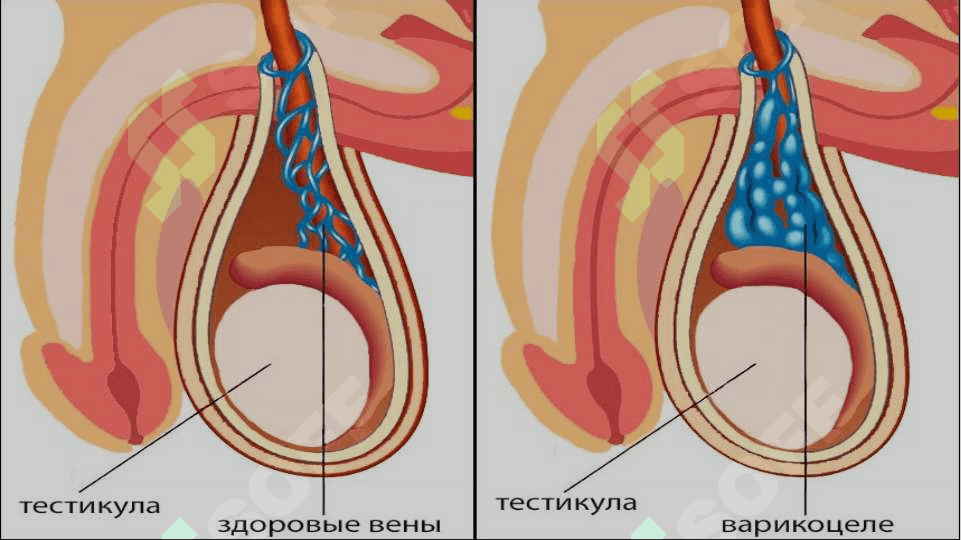 Varikosele kasalligi. 4