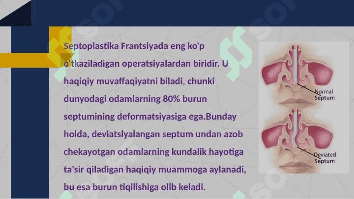 Septoplastika operatsiyasi 3