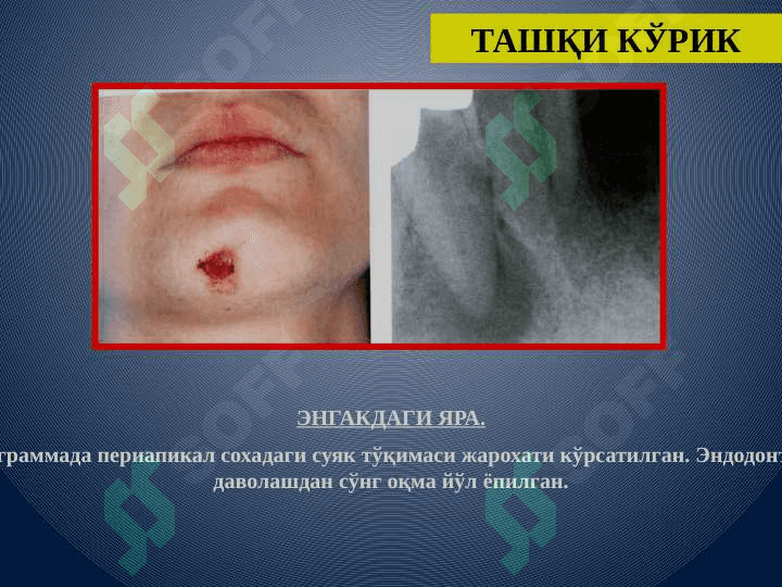 Aholini stomatologik epidemiologik tekshirish usullari 6