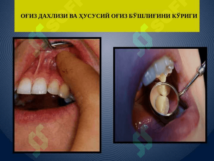 Aholini stomatologik epidemiologik tekshirish usullari 8