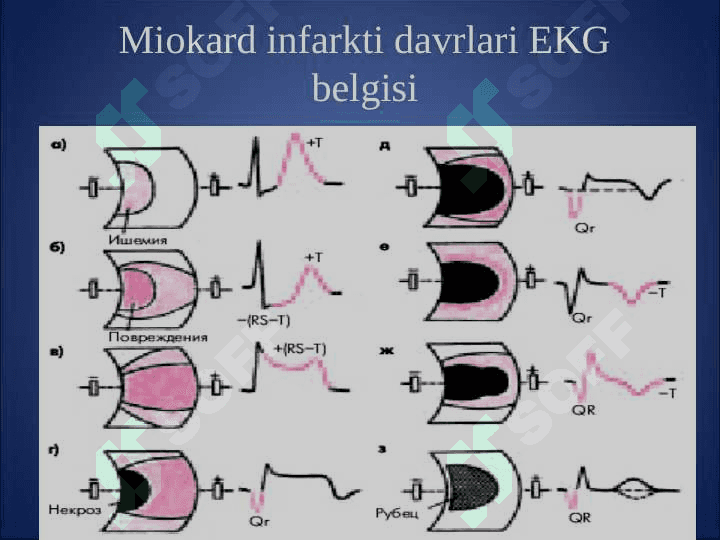 Miokard infarkti 7