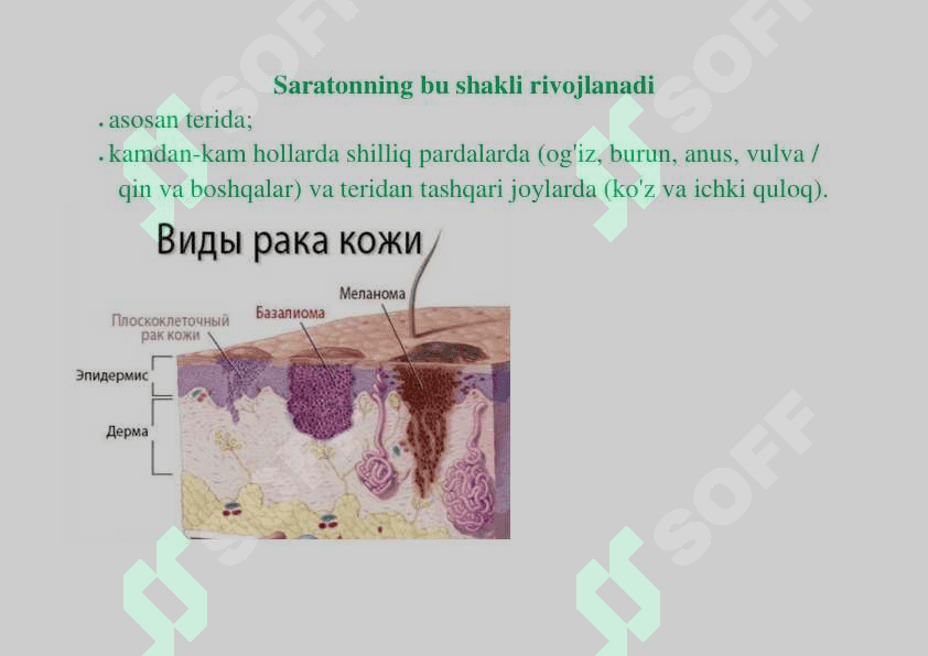 Teri raki, Teri melanomasi turlari Mohidi 4