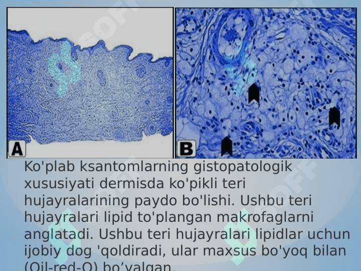 Gidrona va lipoma ppt 5