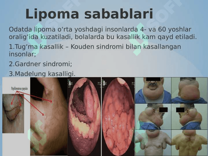 Gidrona va lipoma ppt 8