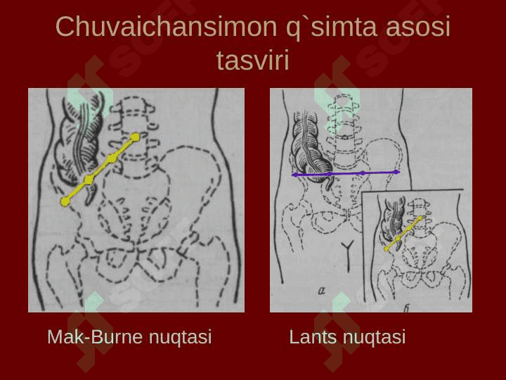 Qorin old-yon devorining klinik anatomiyasi. Churralar va ularda operatsiyalar. 4