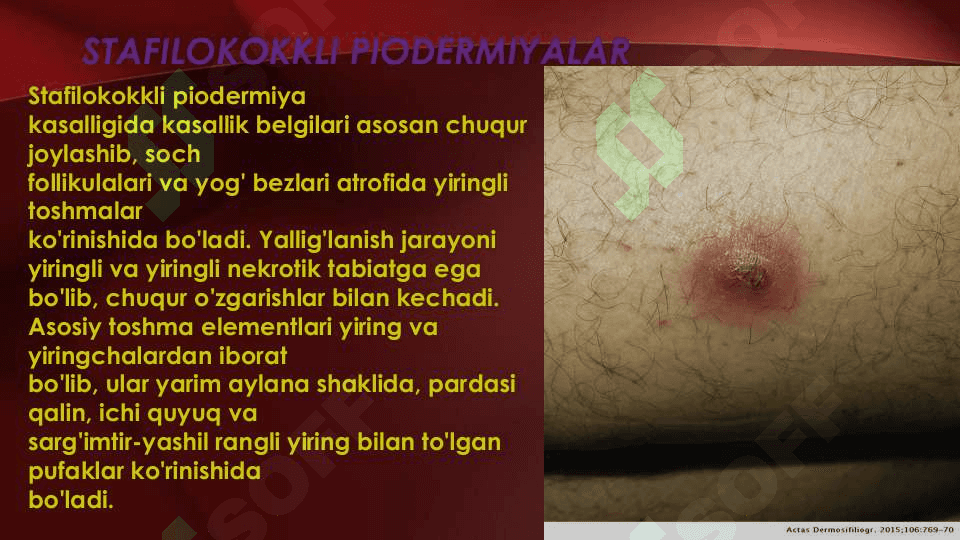 Terining yiringli kasalliklari.Etiologiyasi, patogenezi. Piodermiyalarni umumiy kechishi. Stafilodermiyalar, oddiy husnbuzar.Streptodermiyalar.Bolalarda uchraydigan stafilodermiyalar. Piodermiyalarni davolash. 5