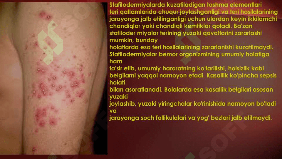 Terining yiringli kasalliklari.Etiologiyasi, patogenezi. Piodermiyalarni umumiy kechishi. Stafilodermiyalar, oddiy husnbuzar.Streptodermiyalar.Bolalarda uchraydigan stafilodermiyalar. Piodermiyalarni davolash. 6