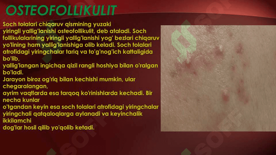 Terining yiringli kasalliklari.Etiologiyasi, patogenezi. Piodermiyalarni umumiy kechishi. Stafilodermiyalar, oddiy husnbuzar.Streptodermiyalar.Bolalarda uchraydigan stafilodermiyalar. Piodermiyalarni davolash. 8