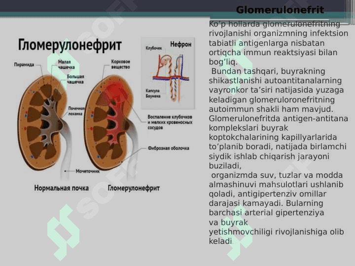 Glomerulonefrit , Endokardit , Yarali Kolit. 2