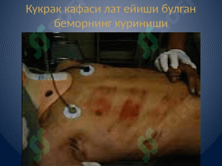 Ko'krak qafasining travmatik shikastlanishlari 4