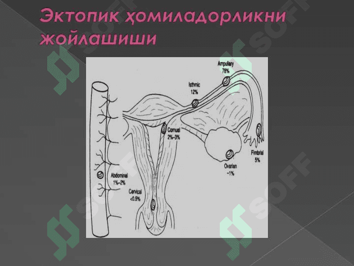 Bachadondan tashqari homiladorlik . 6