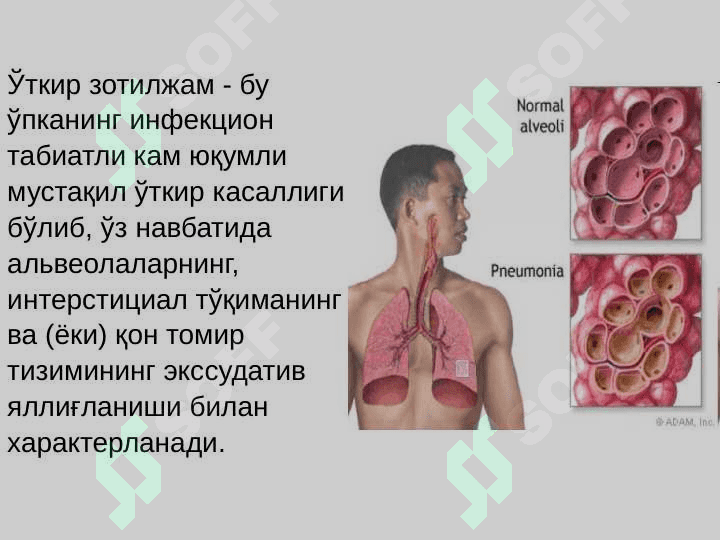 O`tkir pnevmoniya . Otkir pnevmoniyalar . 6