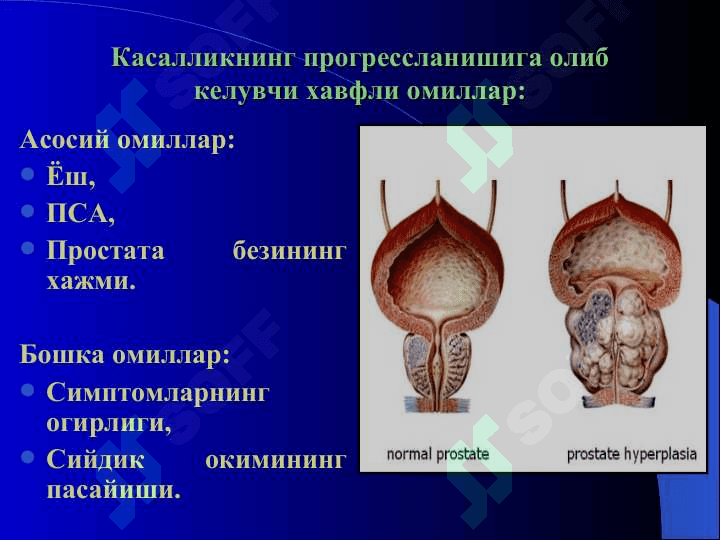 Prostata bezi havfsiz giperplaziyasi 6