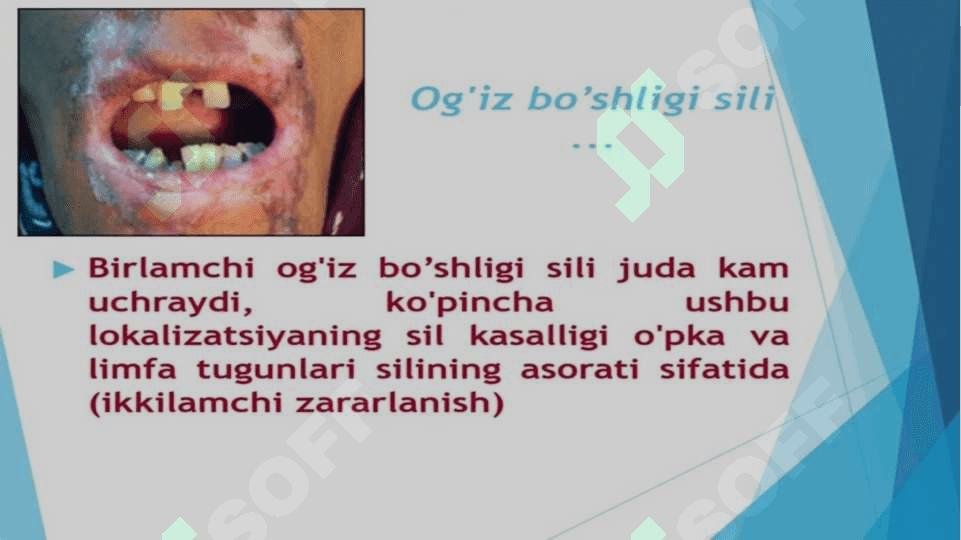 Sil kasalligi. Sil kasalligida og’iz bo’shlig’ida bo’ladigan o’zgarishlar. Ularni tashxislash va davolash. 7
