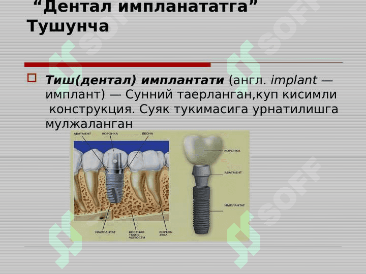 Implantlar yordamida tishlarning to'liq yo'qligini davolashning klinik protokollari. Axen tushunchasi, Abatment turlari, implantlarning analoglari. 2
