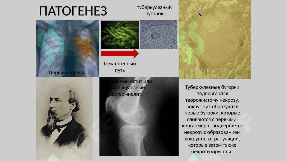 Xirurgik sil . Хирургический туберкулёз 3