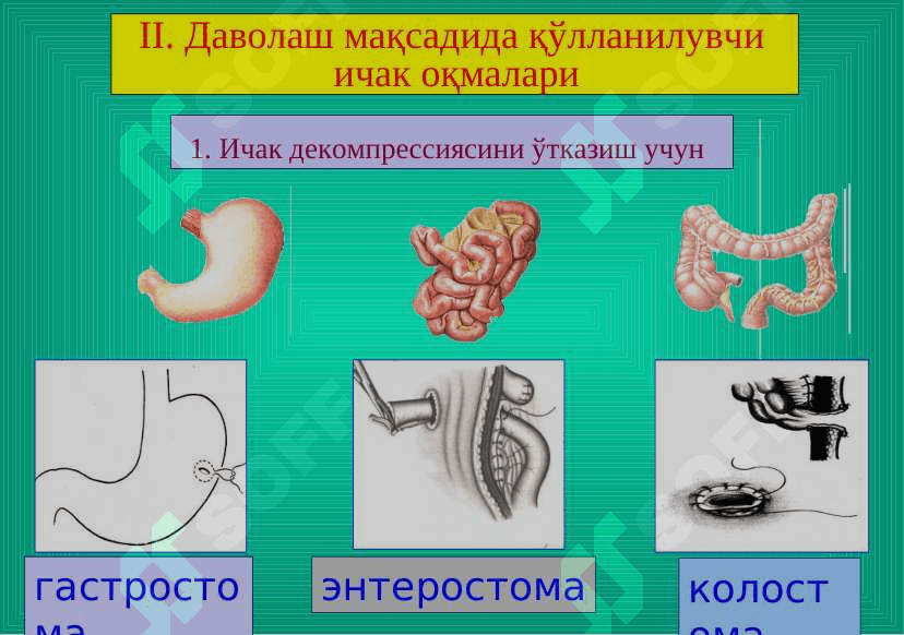 Ichak oqmalari . Ичак оқмалари 3