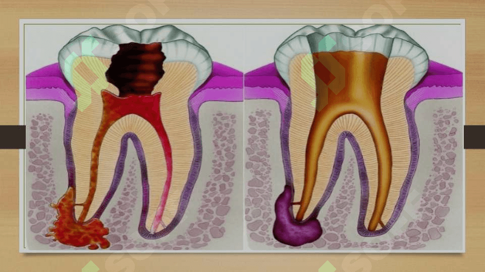 Yondosh kasalliklarida surunkali periodontitlarni davolashning o’ziga xos taktikasi 4