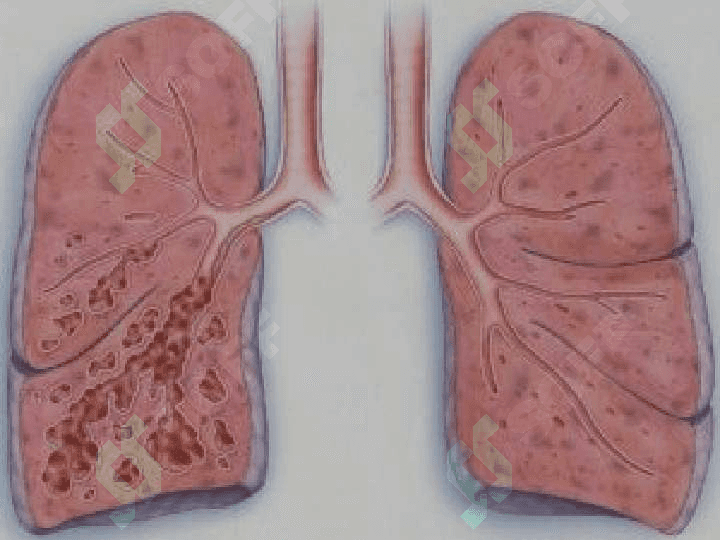 Bronxoektatik kasallik diagnostikasi 4