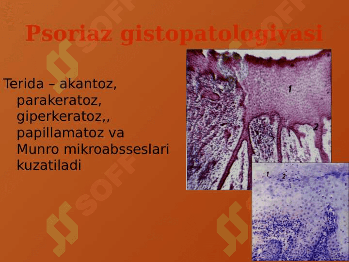 PSORIAZ vaQIZIL YASSI TEMIRATKINING ATIPIK TURLARI 4