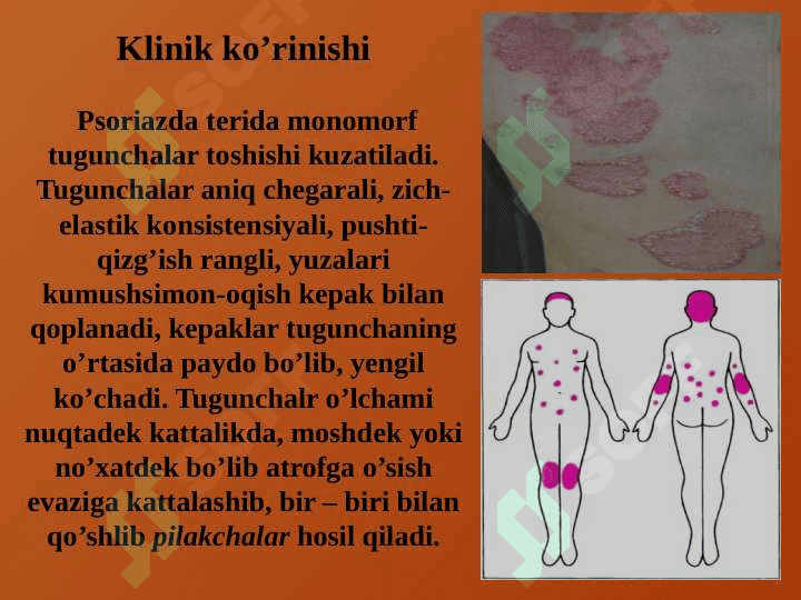 PSORIAZ vaQIZIL YASSI TEMIRATKINING ATIPIK TURLARI 5