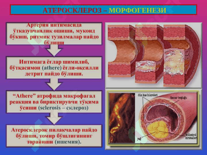Атеросклероз. Гипертония касаллиги 4