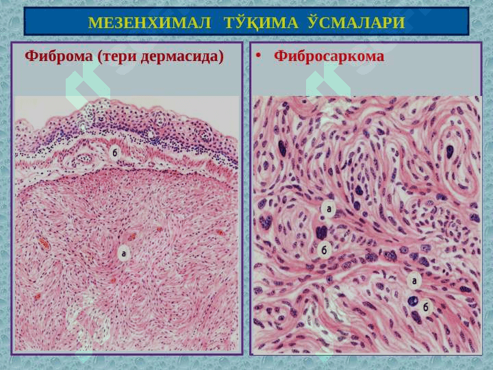 Мезенхимал, меланинли ва нерв тўқима ўсмалари 4