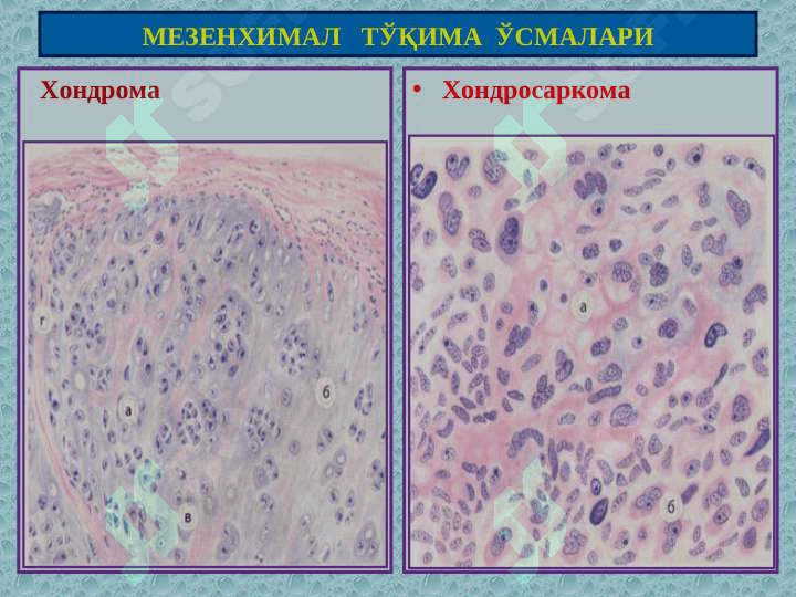 Мезенхимал, меланинли ва нерв тўқима ўсмалари 5
