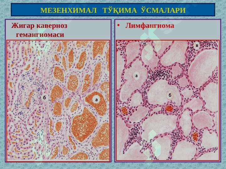 Мезенхимал, меланинли ва нерв тўқима ўсмалари 6