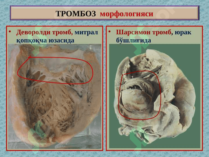 Тромбоз. Эмболия. Стаз. Инфаркт 7