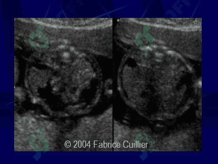Perinatal Infections Fetal Infection 7