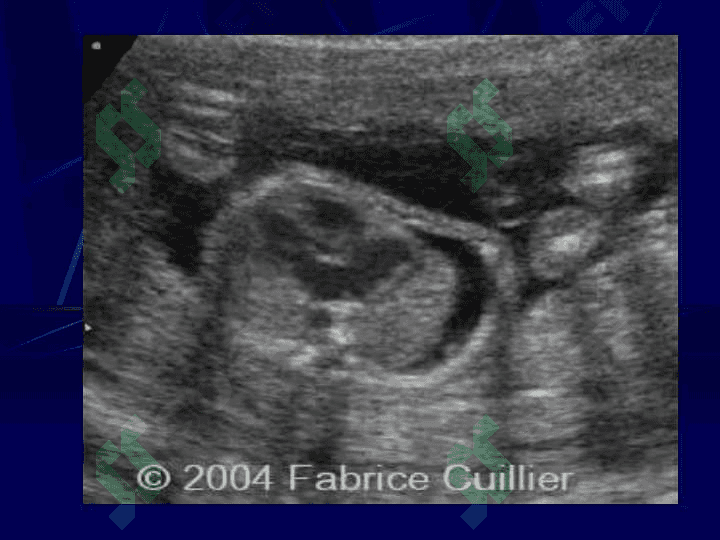 Perinatal Infections Fetal Infection 8